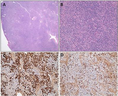 Vasculitis in a Child With the Hyper-IgM Variant of Ataxia-Telangiectasia